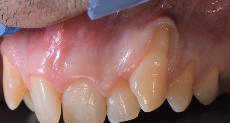 Cirugía Plástica de la encía