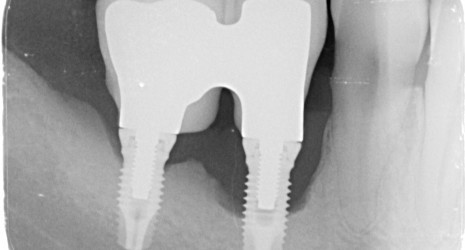Tratamiento de la perimplantitis