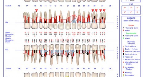 Tratamiento de la Enfermedad Periodontal