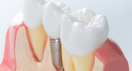 Implantes dentales